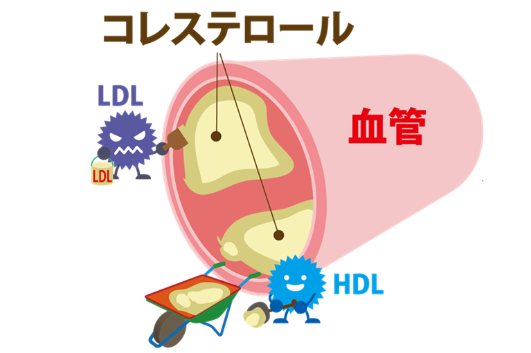 LDL（悪玉）コレステロールが高いとどうなるの？