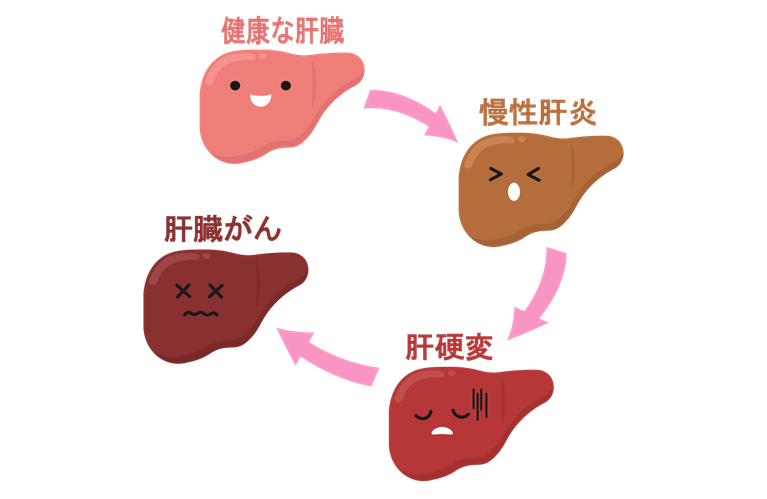 肝臓の炎症が長期間続く慢性肝炎